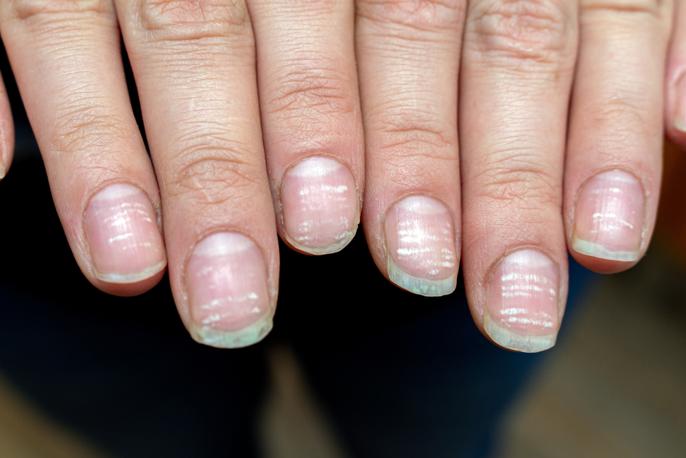Gel Nail Allergy: Safety, Concerns, and Prevention Tips | Allure